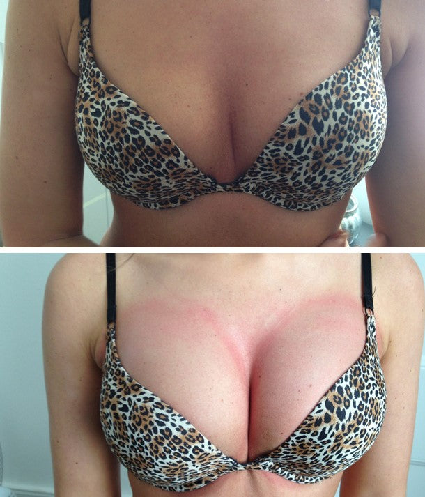 BREAST Lift/Enhancement