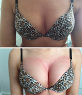 BREAST Lift/Enhancement